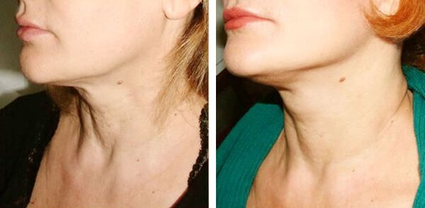 before and after laser skin rejuvenation photo 1