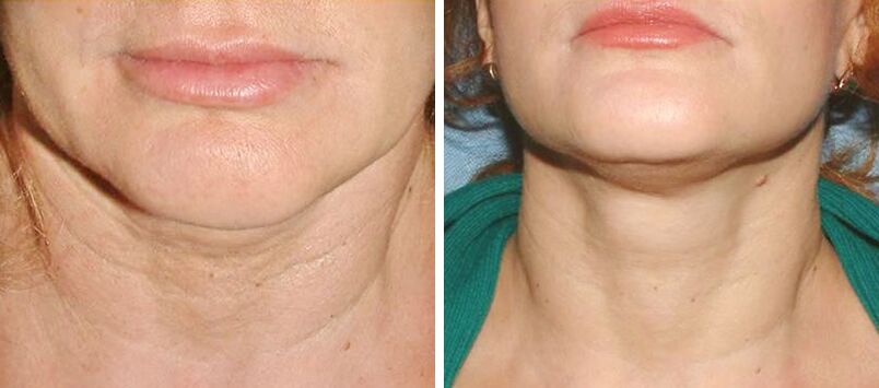 before and after laser skin rejuvenation photo 2