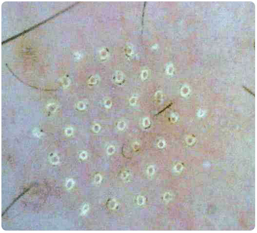 skin under a microscope after fractional rejuvenation