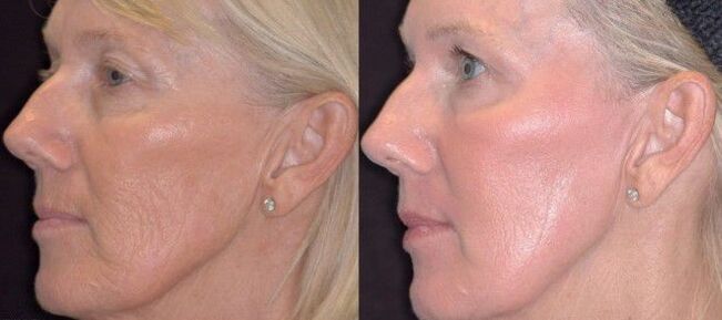 before and after fractional skin rejuvenation photo 3