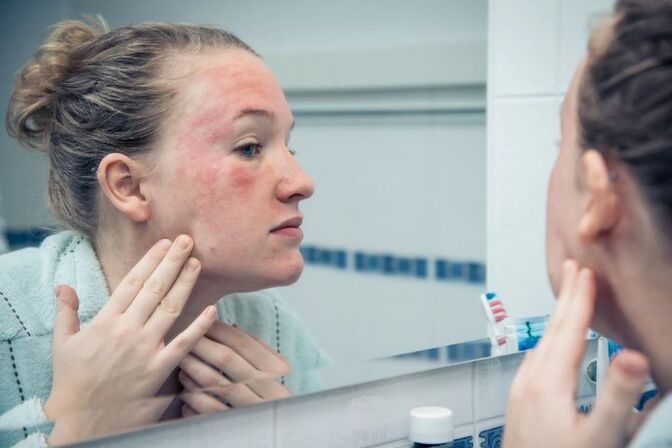 Chronic skin diseases in the aggravation stage