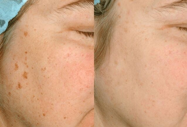 Removing pigmentation on the skin
